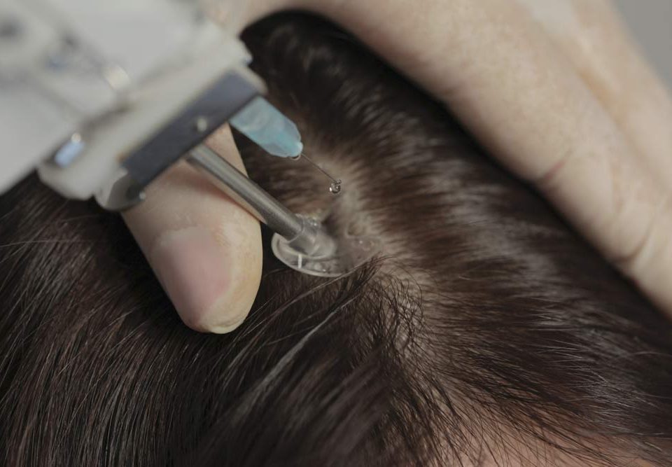 repousse-cheveux-mesotherapie